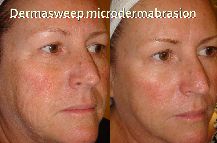 dermasweep---before-and-after